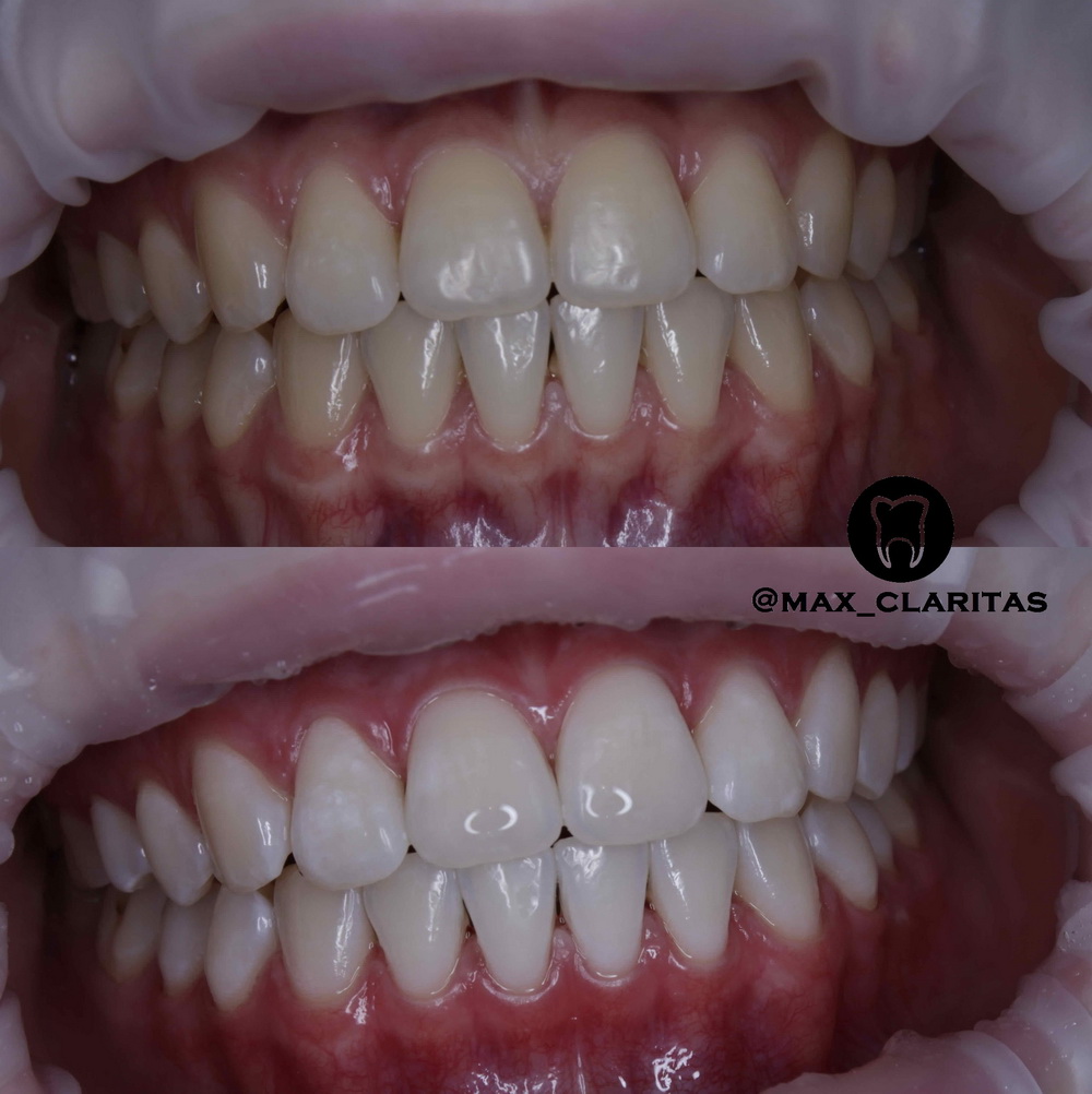Отбеливание зубов в спб - Zoom 4 17500 руб.