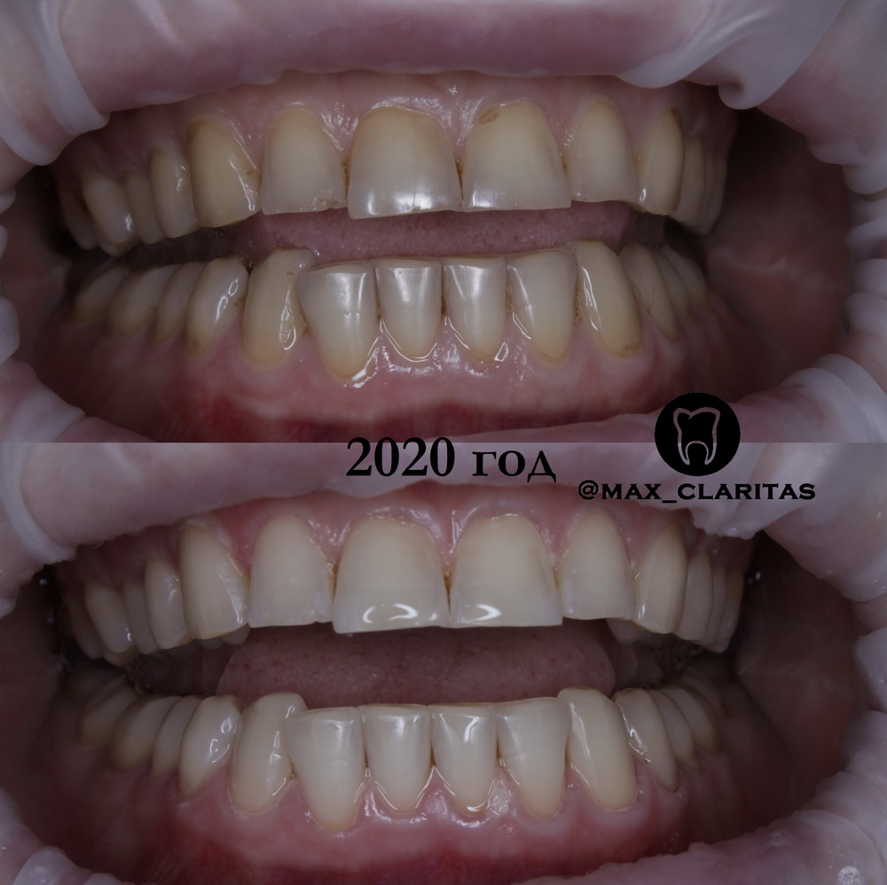 Отбеливание зубов в спб - Zoom 4 17500 руб.
