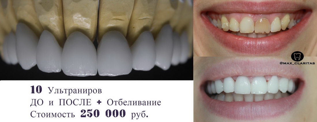 Сколько стоят виниры на зубы в спб
