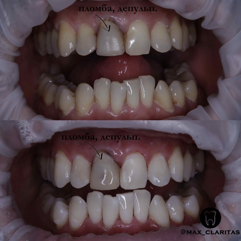 Фото до и после Портфолио работ в стоматологии Киева | Клиника АССА