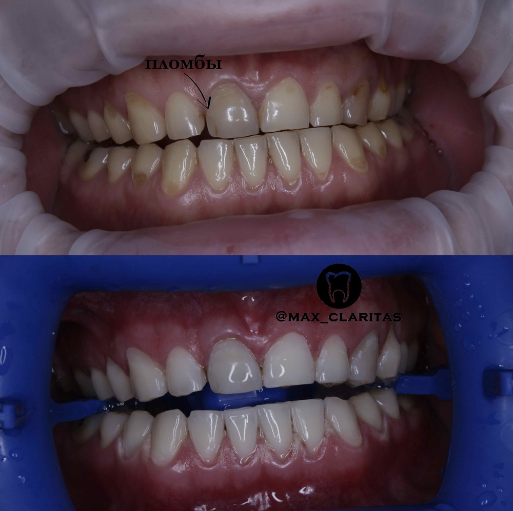 Пломба на передние зубы: фото до и после