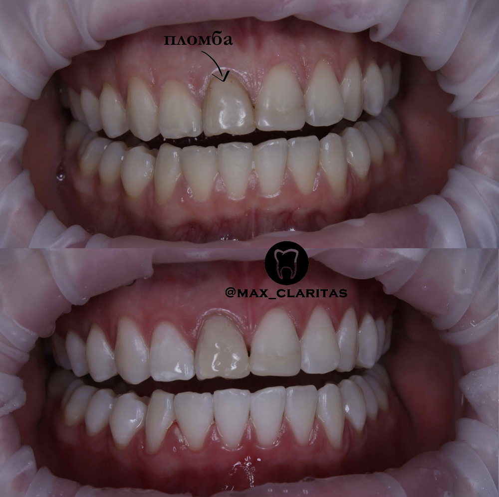 отбеливание пломба на переднем зубе