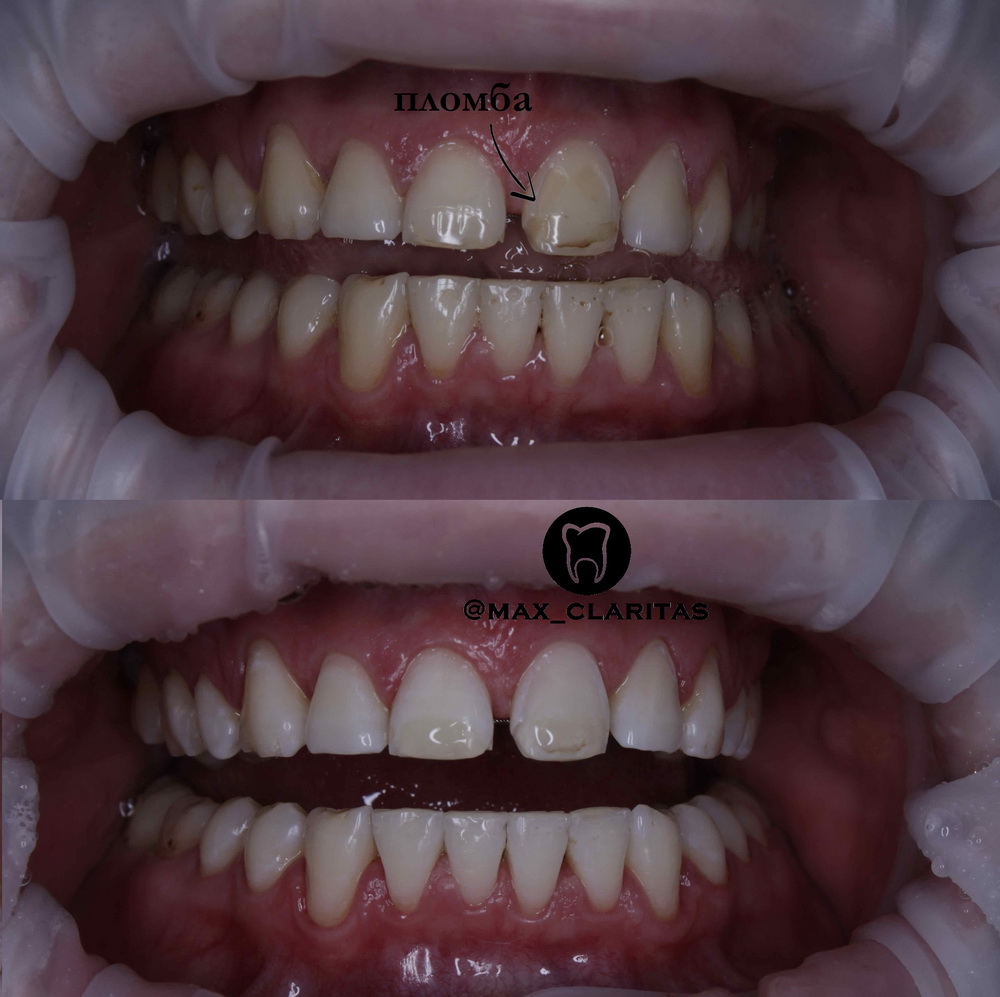 отбеливание зубов если зуб нарощен