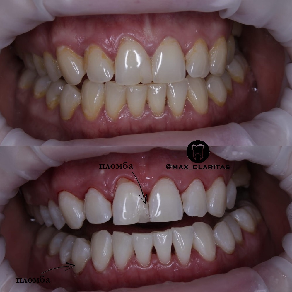 отбеливание зубов спб