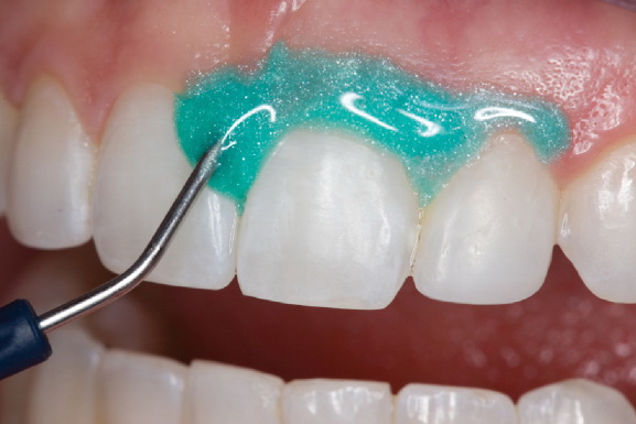 отбеливание зубов этапы